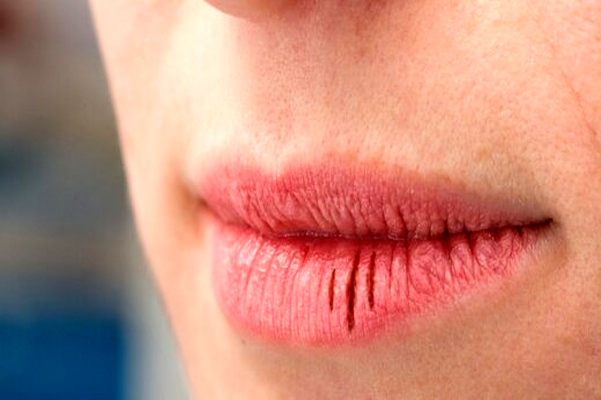 چگونه لب های ترک خورده را درمان کنیم؟