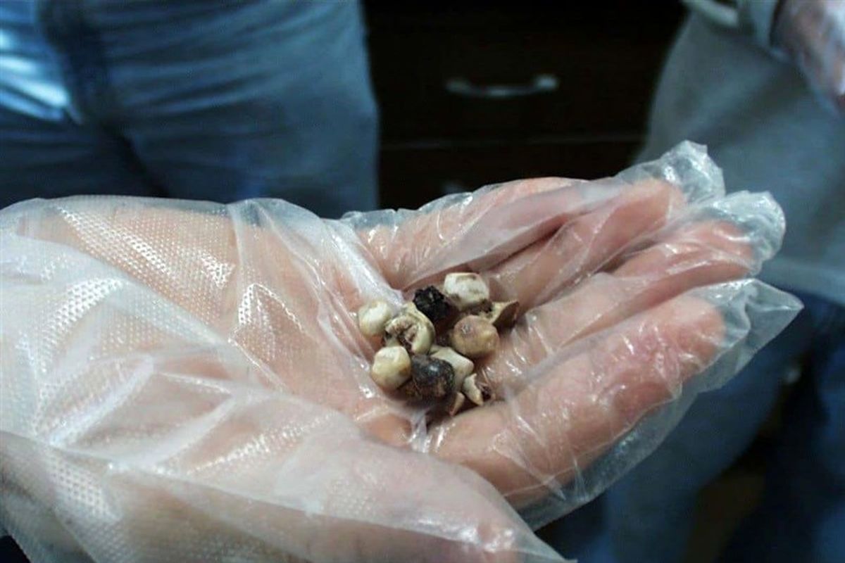 علائم &#۸۲۲۰;سنگ کیسه صفرا&#۸۲۲۱; را بشناسید