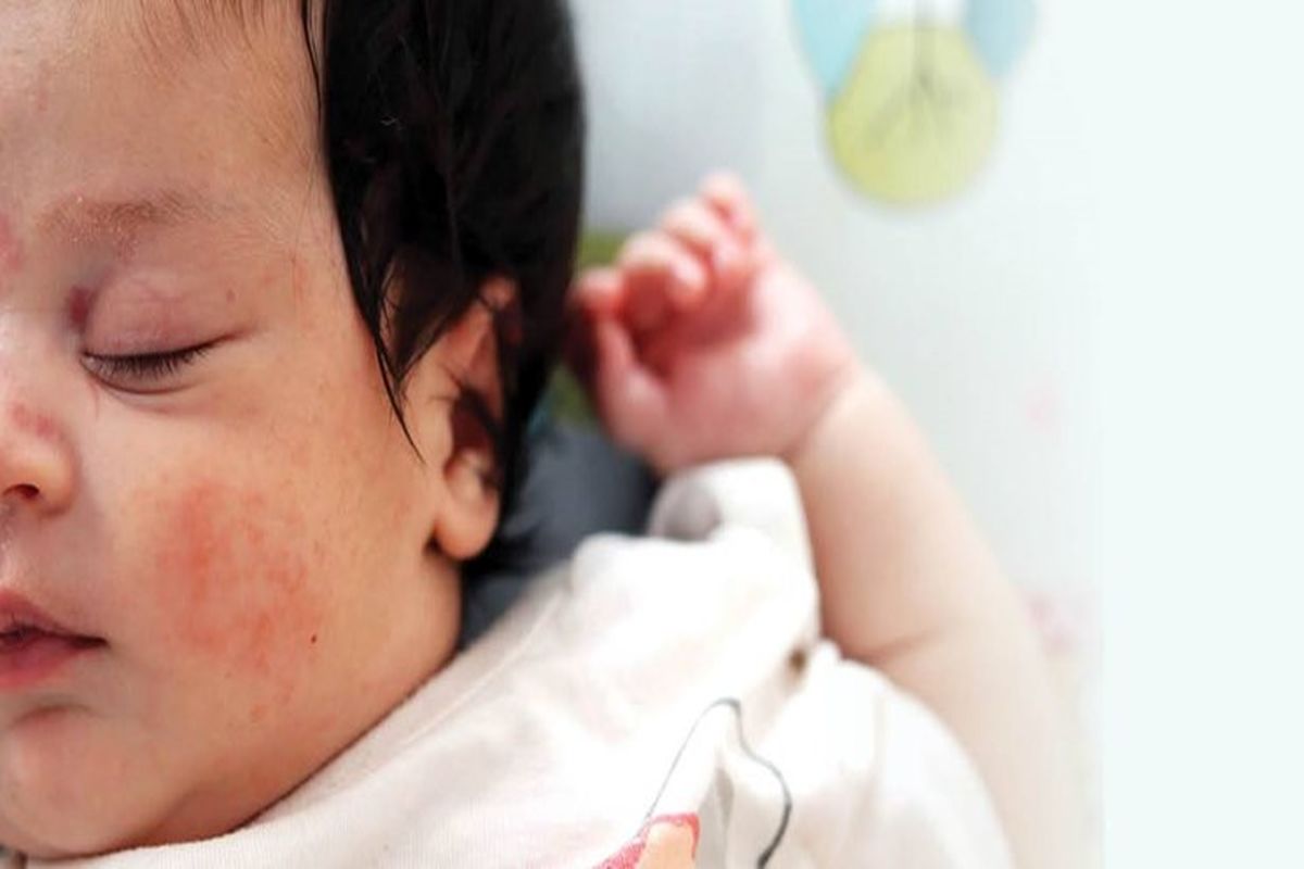 همه چیز درباره علائم حساسیت کودکان