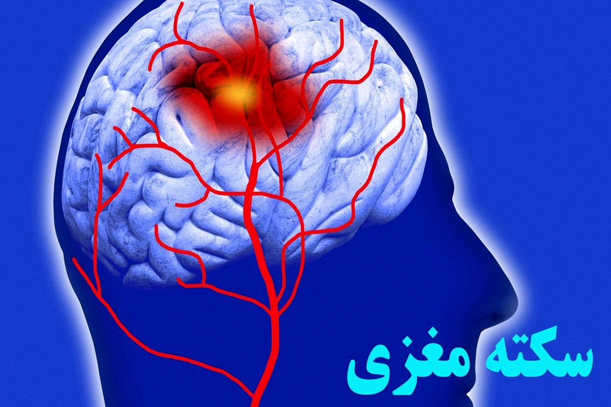شایعه ارتباط کرونا با سکته مغزی