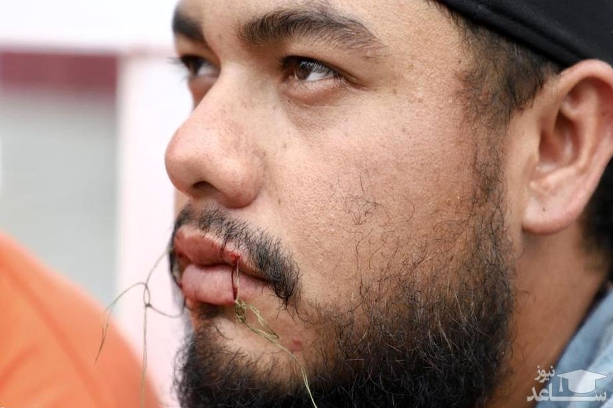 دوختن لب های مهاجران ونزوئلا!