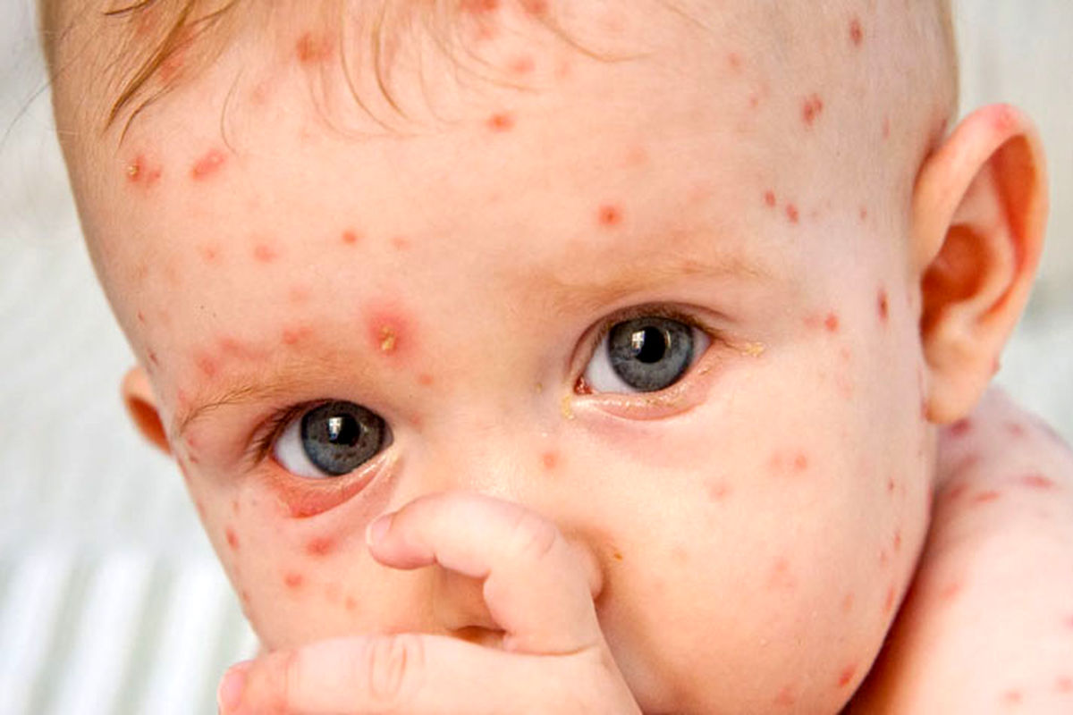 شیوع  بیماری  بسیار مسری سرخک