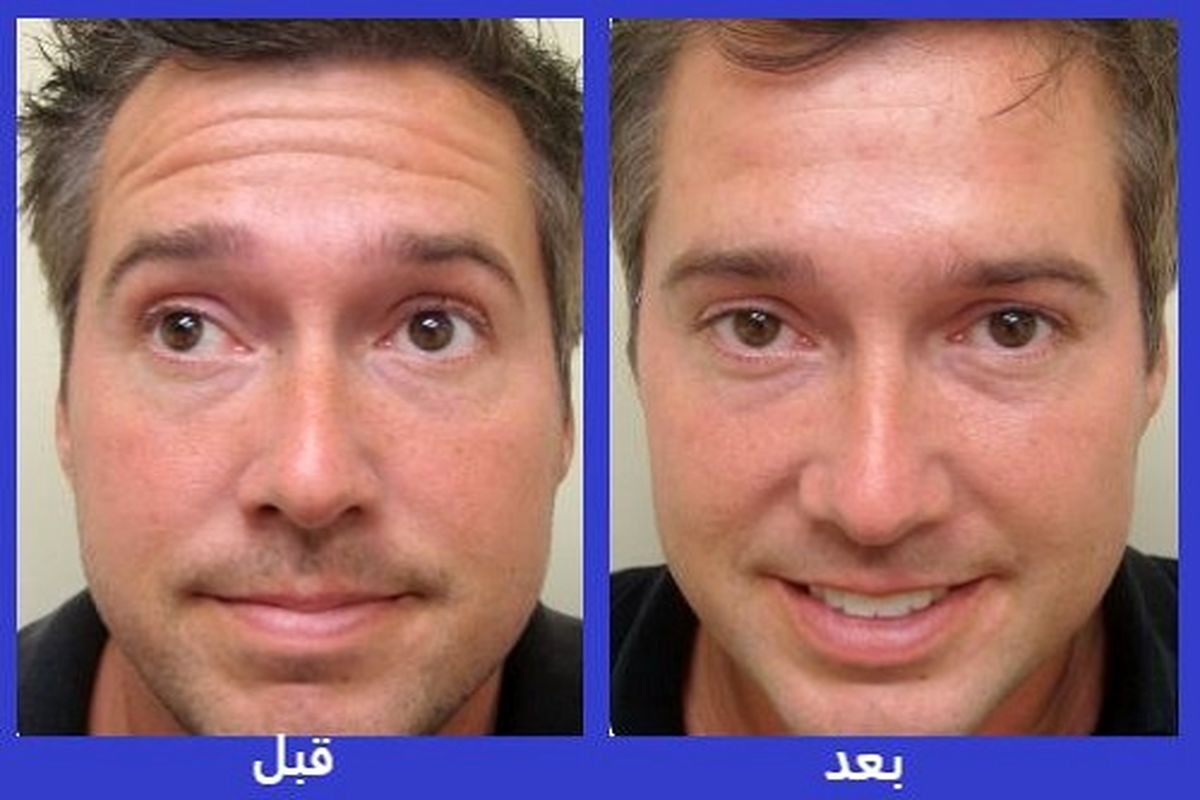 دانستنی های جالب بوتاکس