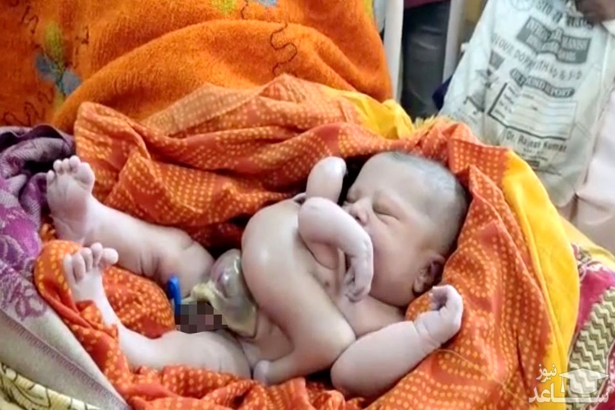 نوزادی شبیه هشت پا