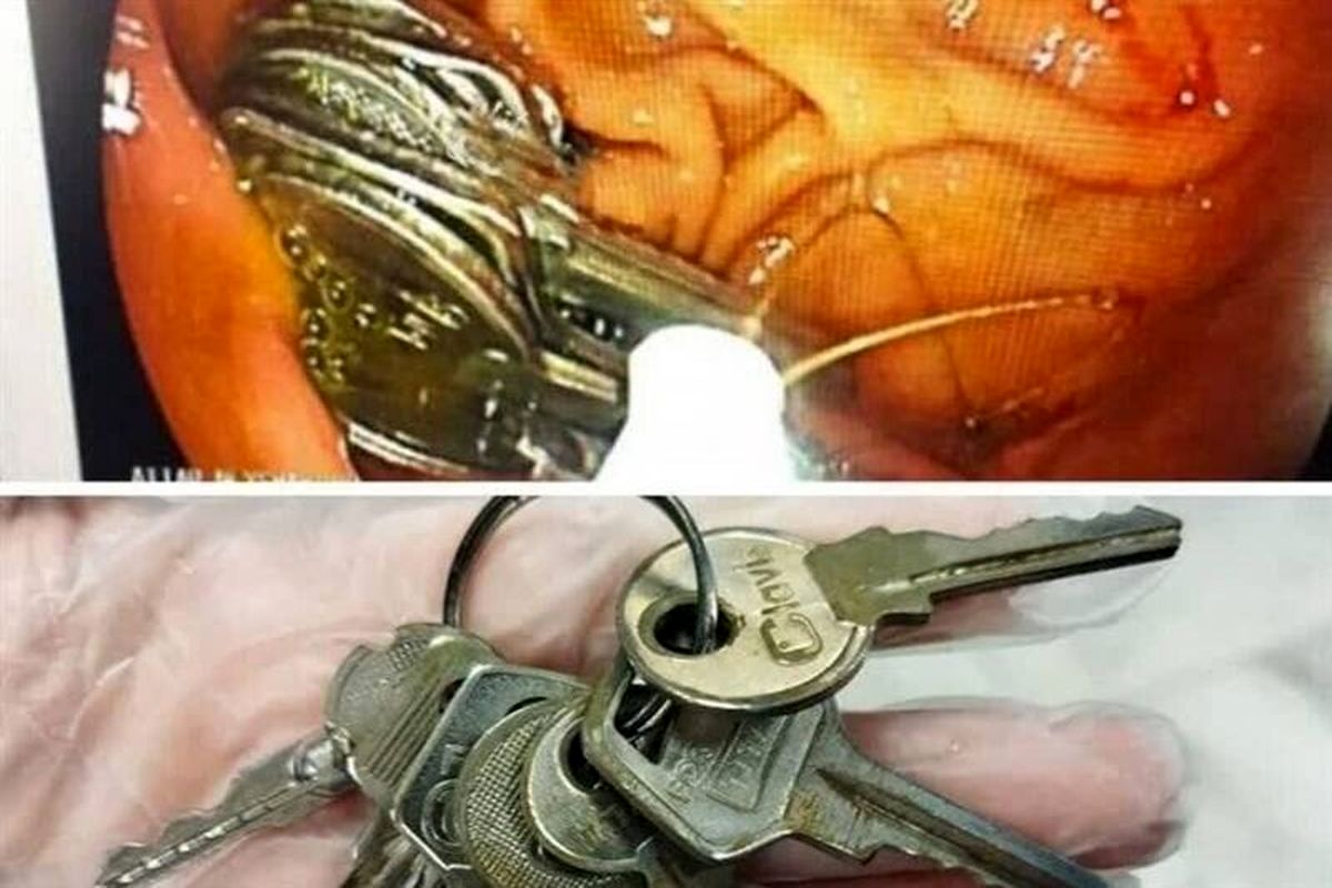 دسته کلیدی در معده که هضم نشد!
