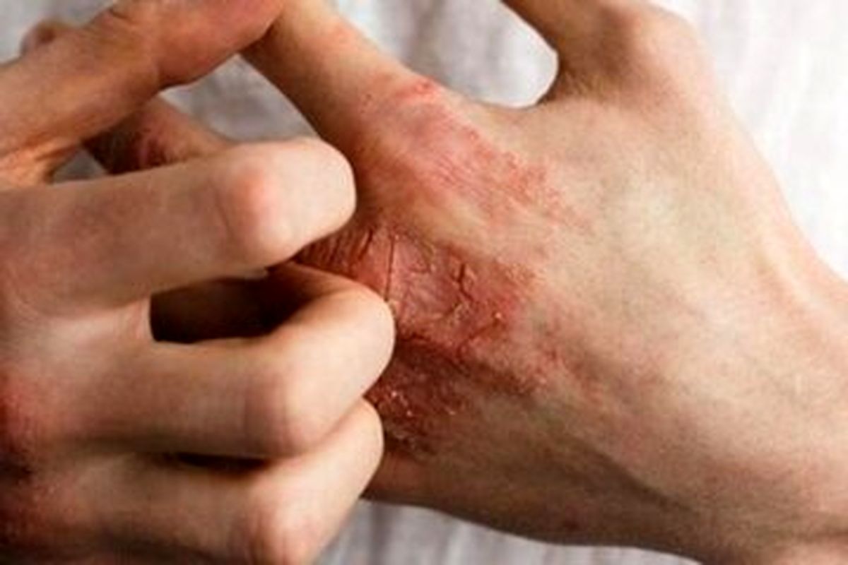 علائم ابتلا به سرطان پوست را بشناسید / علائم کم اهمیت اما خطرناک سرطان پوست