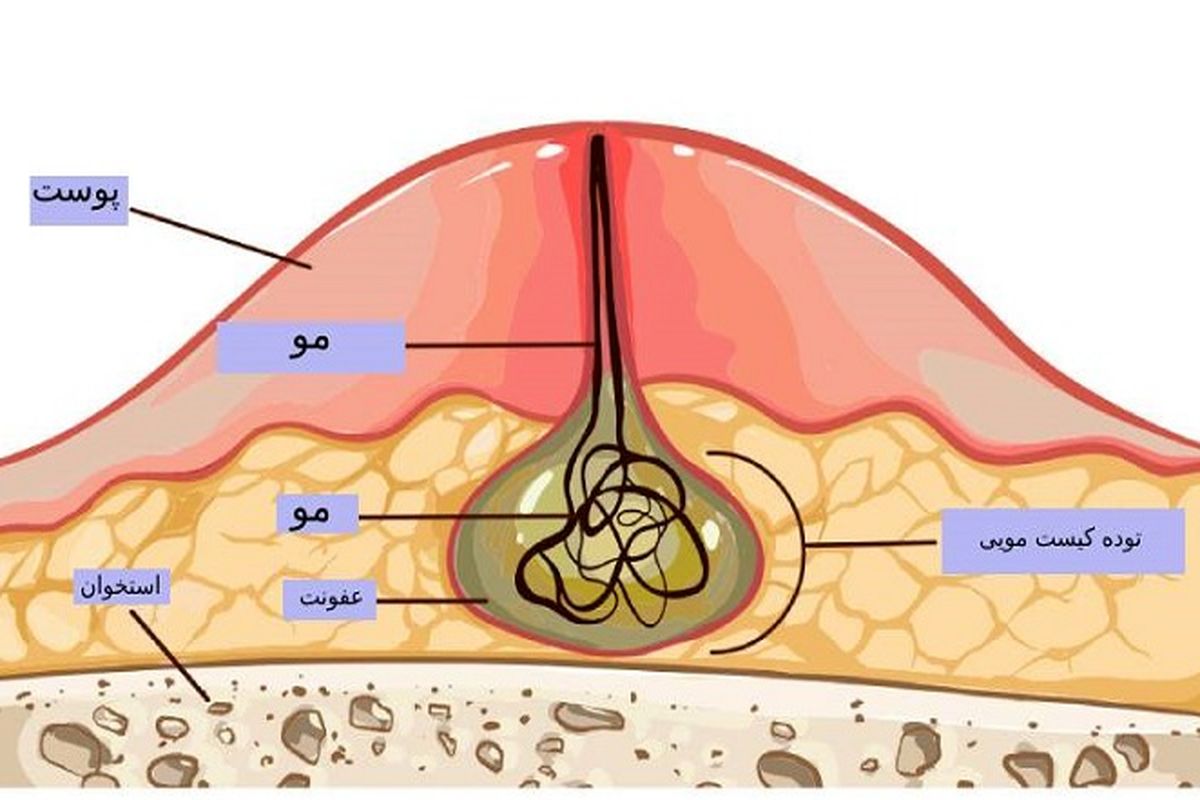 هزینه عمل جراحی کیست مویی در بیمارستان دولتی کمتر است یا کلینیک؟