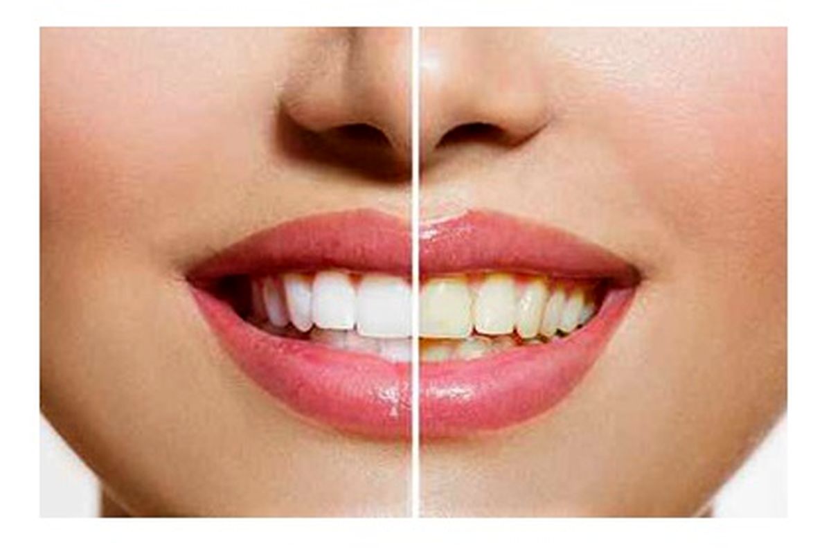 صفر تا صد بلیچینگ دندان