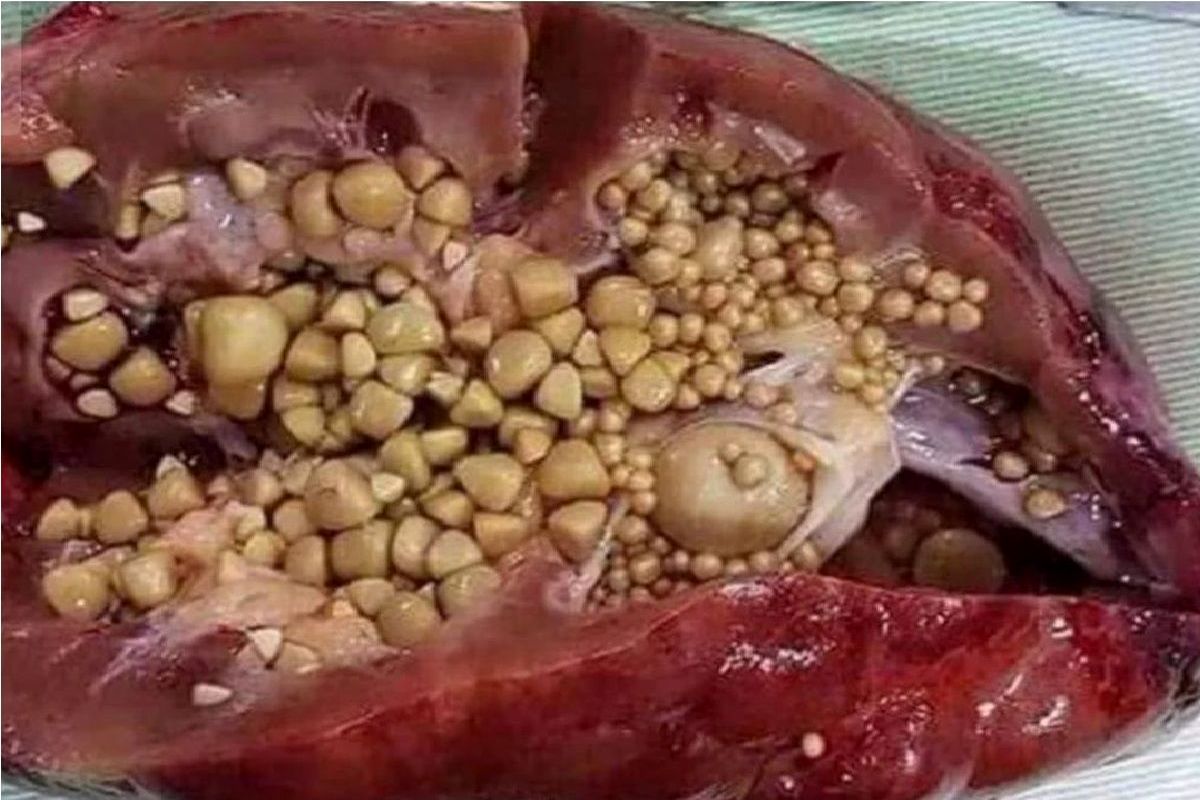 راه‌های پیشگیری از ابتلا به سنگ کلیه