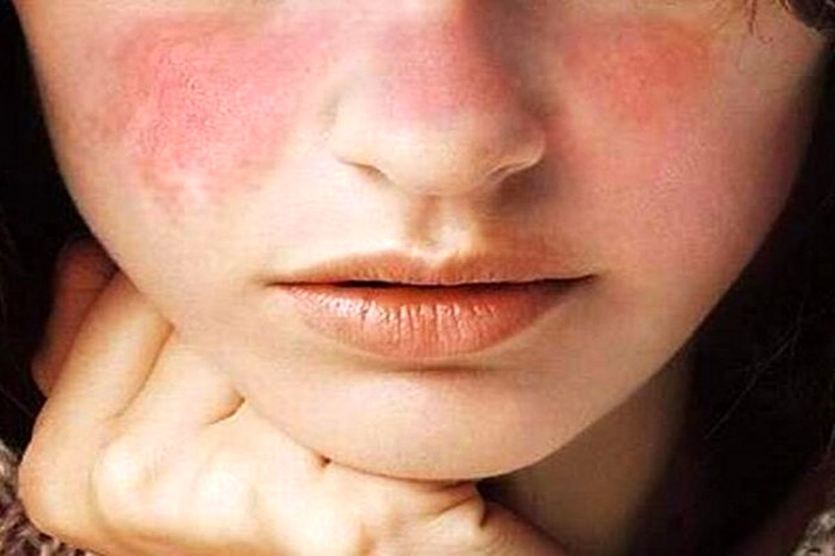 افزایش نگران کننده این بیماری خطرناک در بانوان