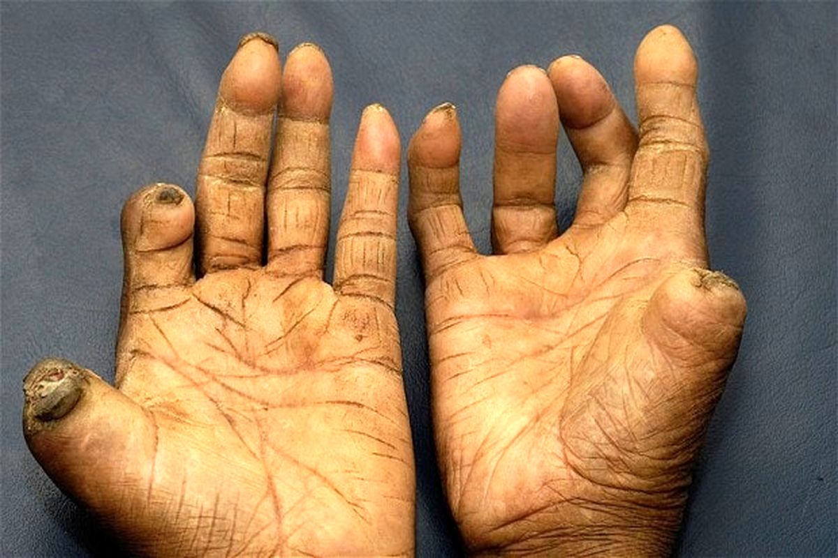 ۷ نفر دیگر جذامی شدند