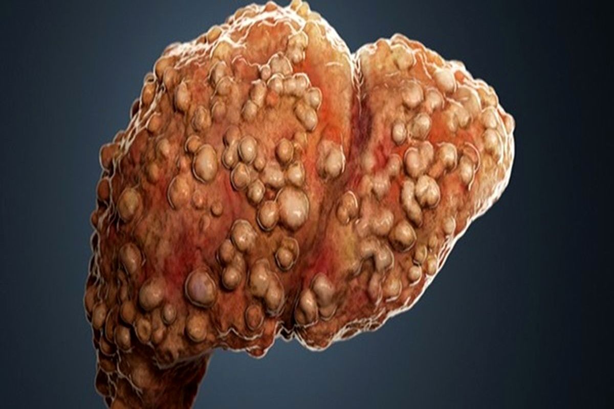 گیاهان دارویی کبد را چرب می کند؟