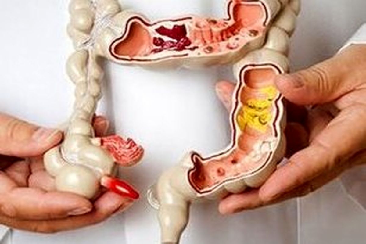 درمان یبوست با نسخه های سنتی /دلایل یبوست از منظر طب سنتی