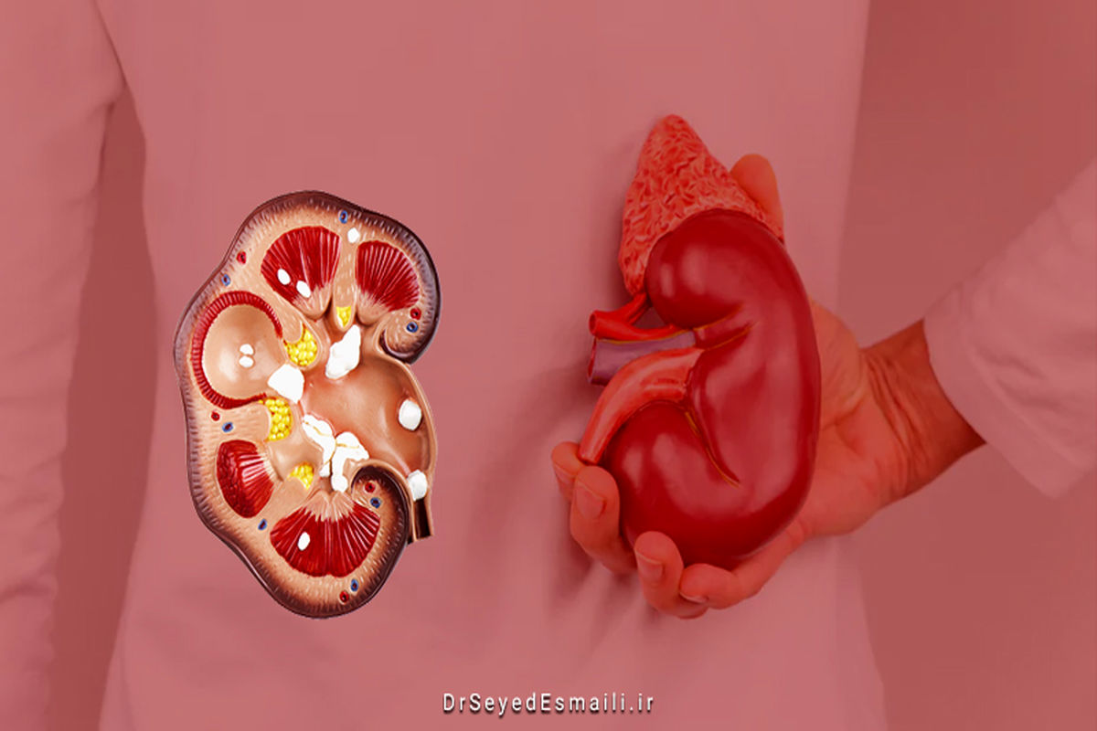 این ۸ خوراکی سنگ کلیه تشدید می کنند / تاثیر عجیب گوشت بر ابتلا به سنگ کلیه