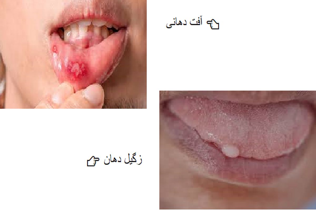 ۷ تفاوت آفت دهان و زگیل دهانی : چطور تشخیص دهیم؟