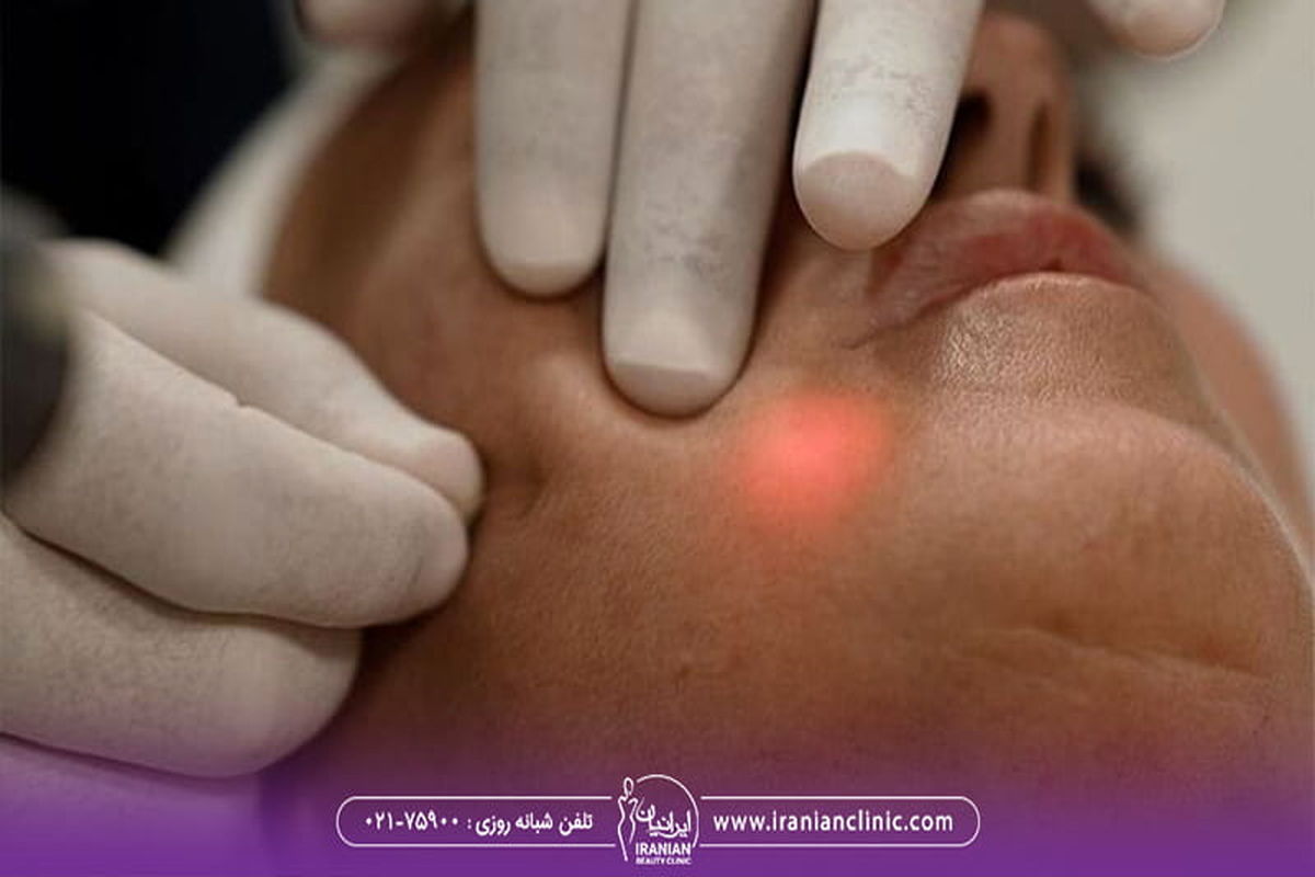 اندولیفت صورت چیست؟