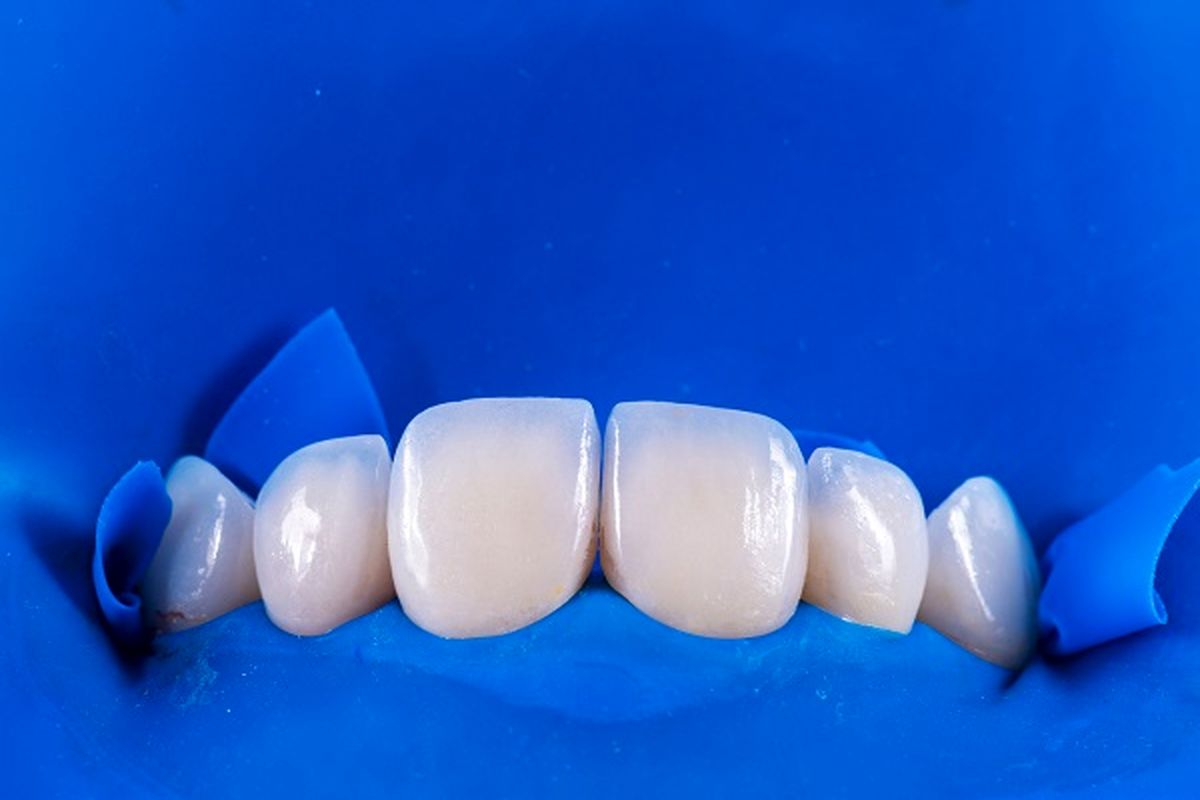 قیمت لمینت دندان در سال ۱۴۰۳