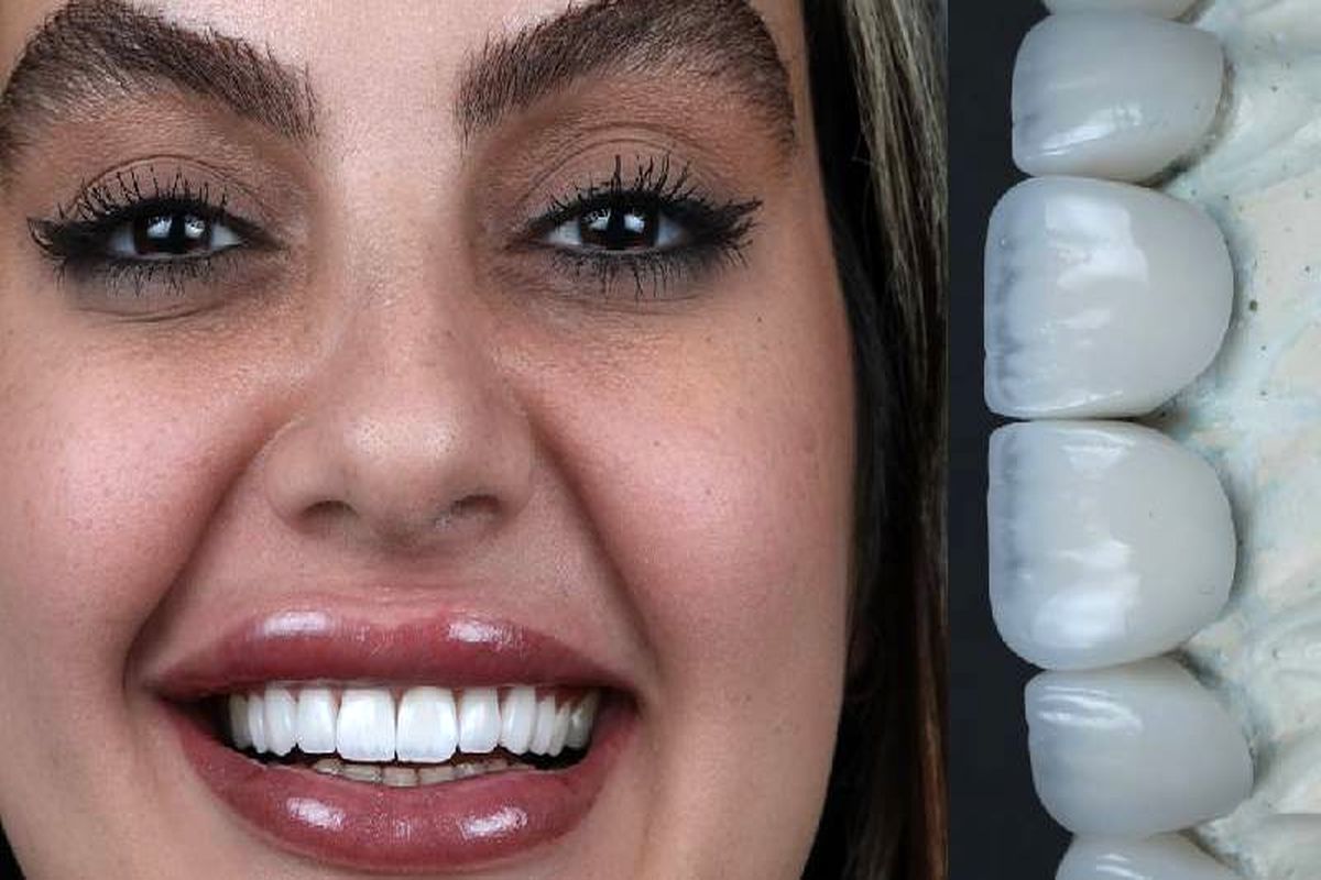 بهترین خدمات کامپوزیت دندان با تکنیک های پیشرفته