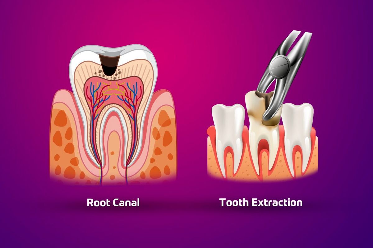 عصب‌کشی یا کشیدن دندان؛ کدام گزینه از نظر هزینه و کیفیت مقرون‌به‌صرفه‌تر است؟
